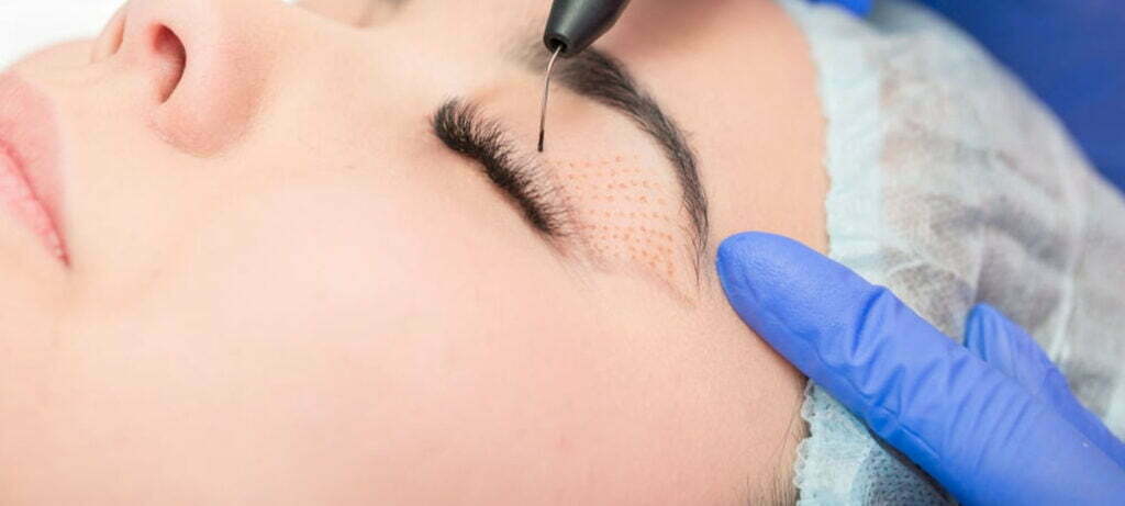 Blefaroplastia sem corte