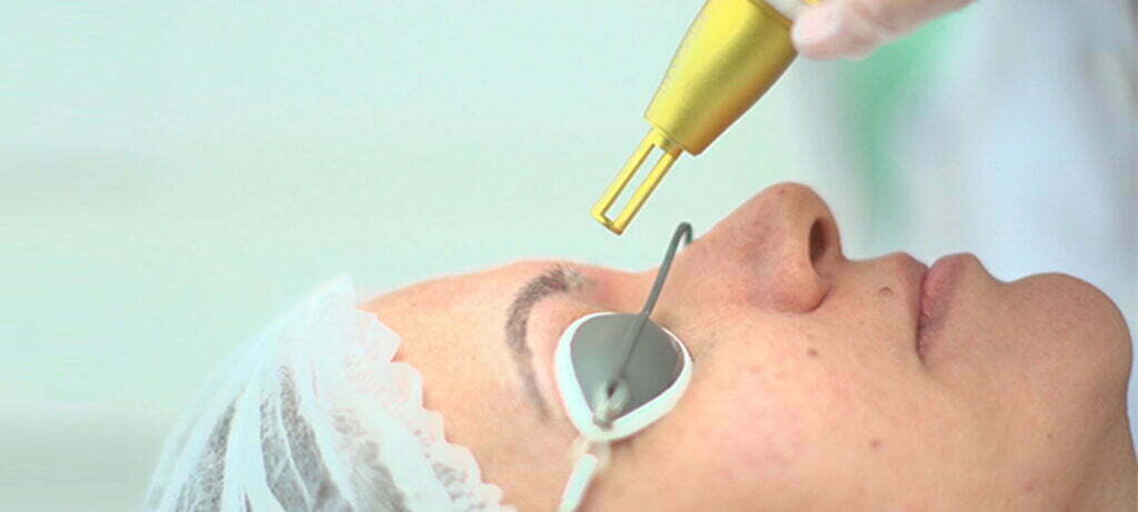 Remoção de Micropigmentação Laser
